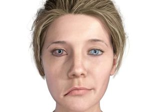 Fazialisparese – Gesichtslähmung